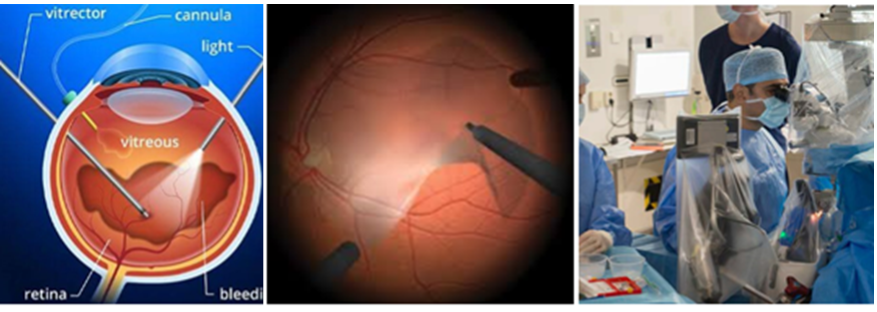 Figure 1: Left: Illustration of retina surgery and a vitrectomy task; middle: illustration of a peeling task; right: PREC's robotic assistant PSS during retina surgery at Rotterdam Eye Hospital.